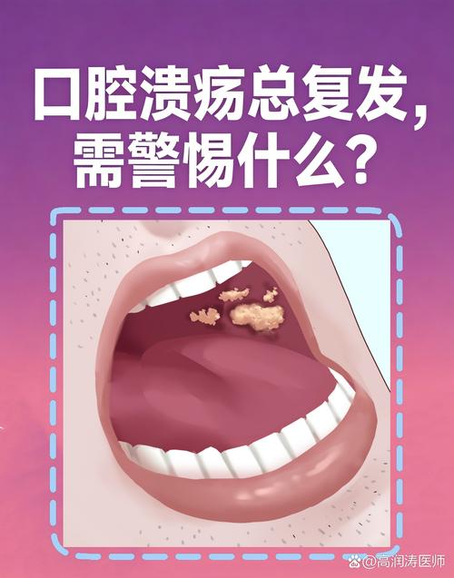 口腔内壁复发性口腔溃疡外观示意图