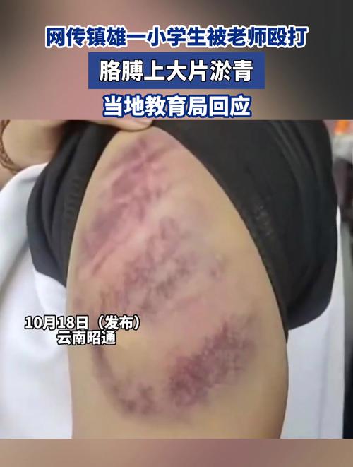 校园欺凌后孩子受伤的胳膊