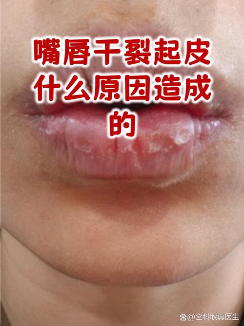 嘴唇干裂脱皮原因排查示意图