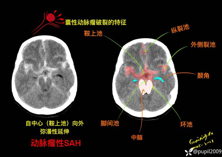 脑裂仲裁双机房quorum示意图