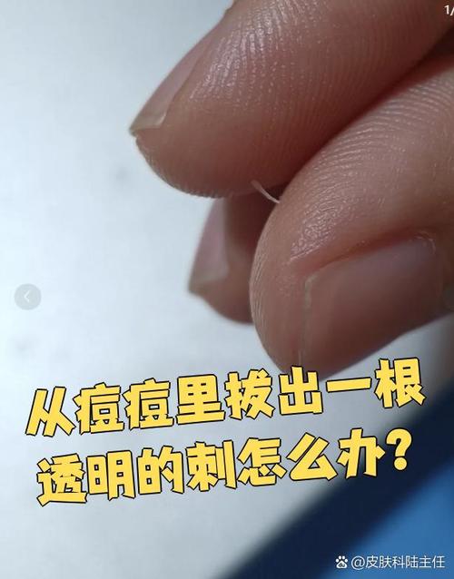 能不能拔掉这根刺?