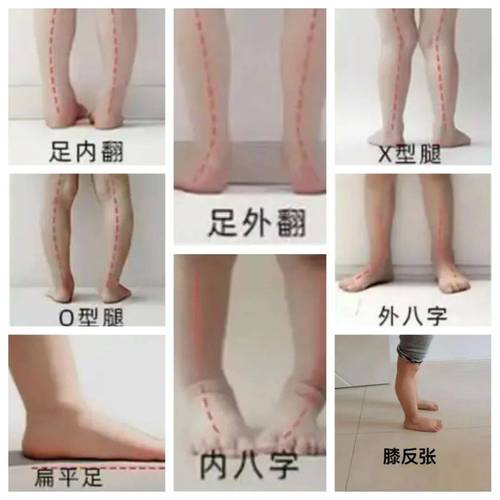宝宝站立足弓发育异常对比图