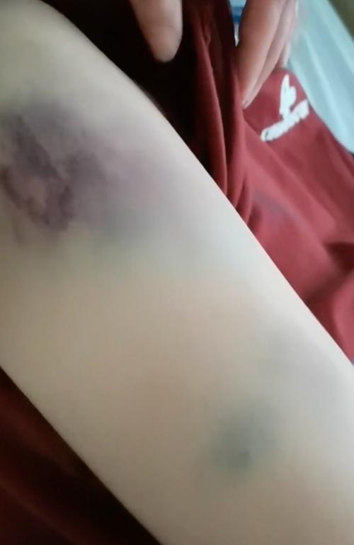 家庭暴力受害人身上淤青伤口照片证据
