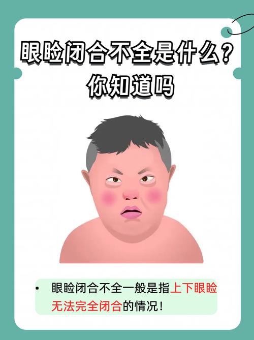 面神经炎的早期眼部保护:别等眼睛出问题才后悔-仁者医