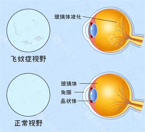 飞蚊症的定期眼底检查重要性:别把眼前的小黑影不当回事-仁者医