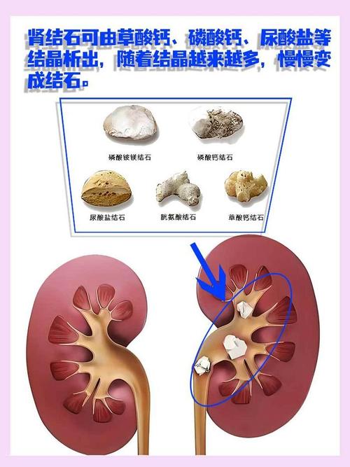 人体肾脏肾结石形成原理示意图