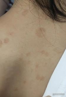 人感染宠物皮肤真菌病腰部症状实拍