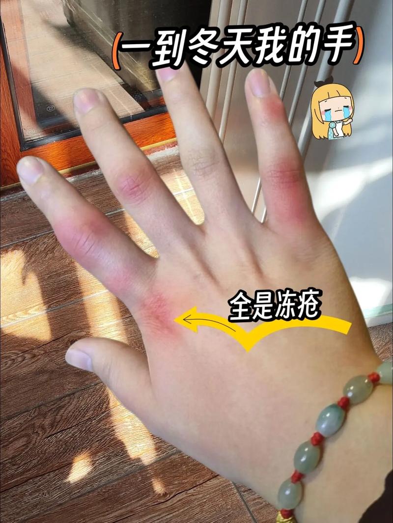 冬天骑电动车没戴防风手套手指冻通红实拍