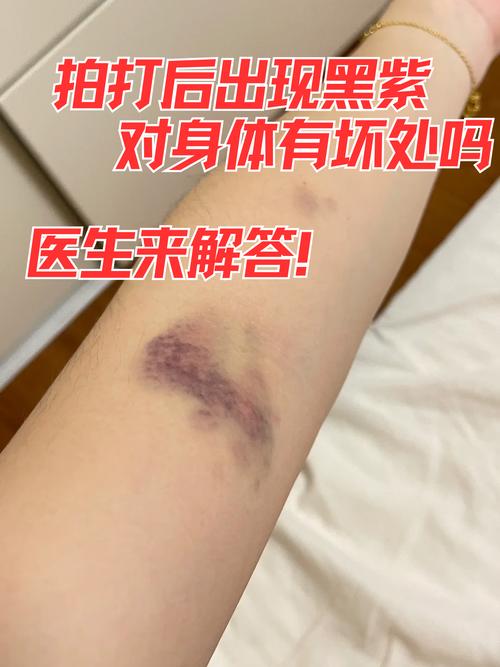 带时间戳的手机拍摄淤青伤处的界面截图