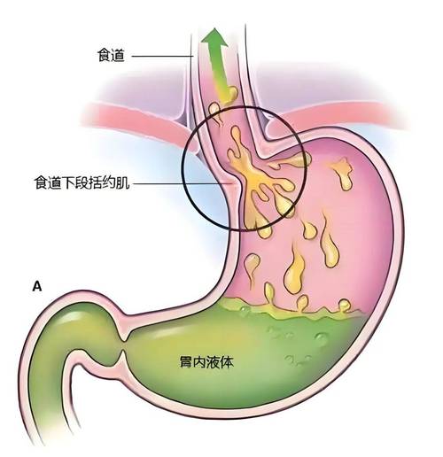 胃食管反流平躺状态解剖示意图