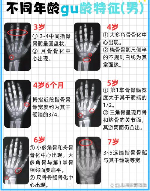儿童左手腕骨龄片与生活年龄对比