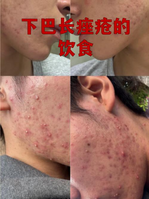 高糖饮食对痤疮皮肤影响对比图