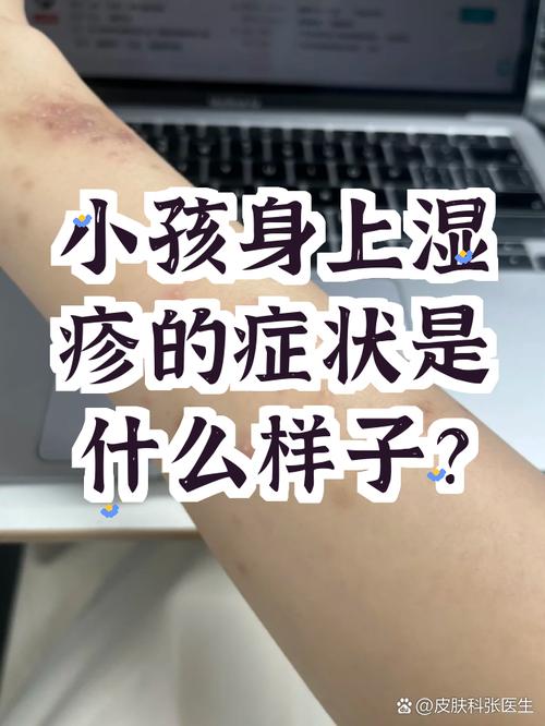婴儿湿疹危险症状就医红线对照表