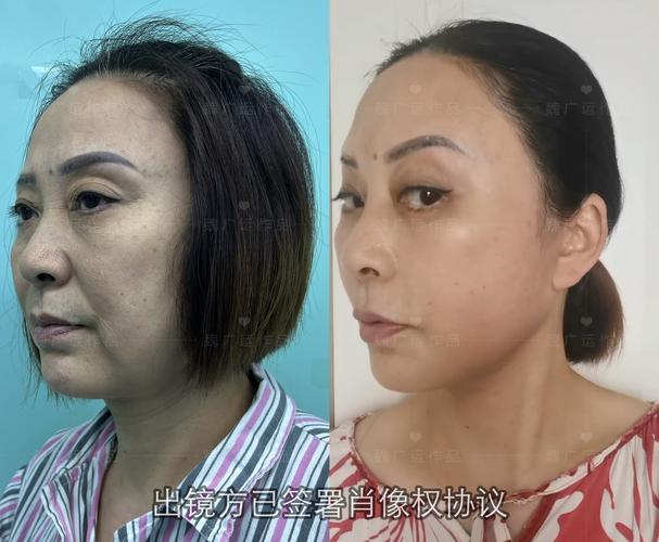 微电流美容仪前后对比效果图