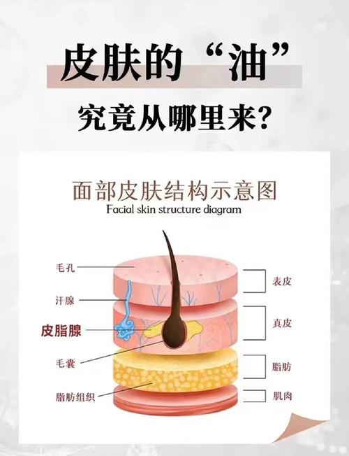 痤疮患者高糖饮食诱发皮脂腺过度出油的机制示意图