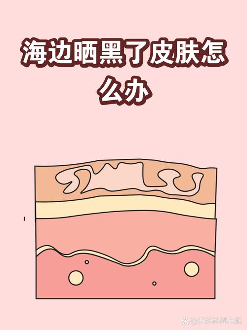 海边游玩晒伤皮肤护理示意图