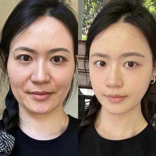 产后女性面部皮肤状态对比实拍