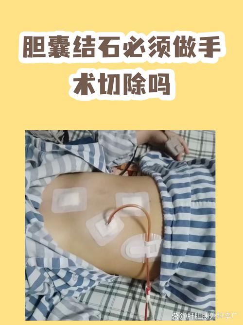 得了结石一定要挨一刀吗