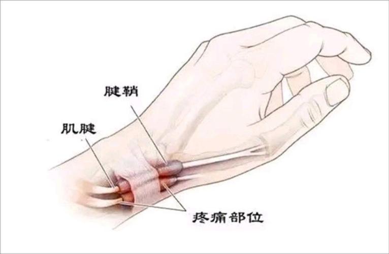 新手妈妈抱娃诱发妈妈手腕疼痛解剖示意图