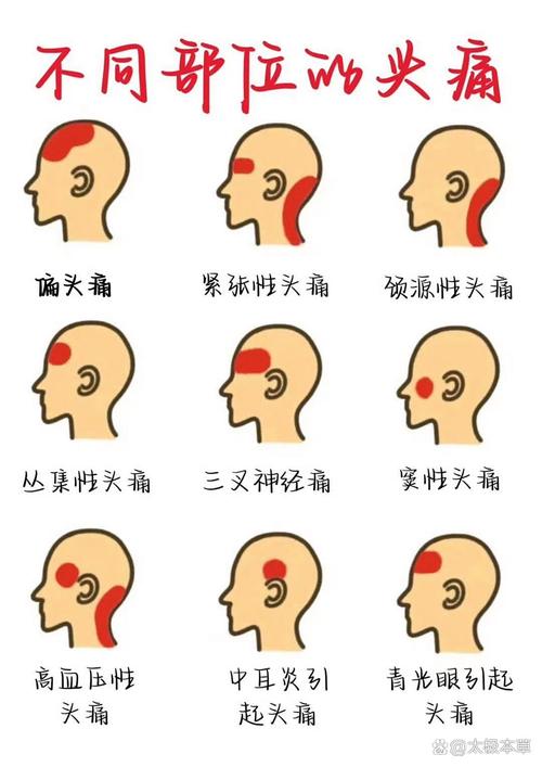 偏头痛体感先兆身体麻木区域示意图