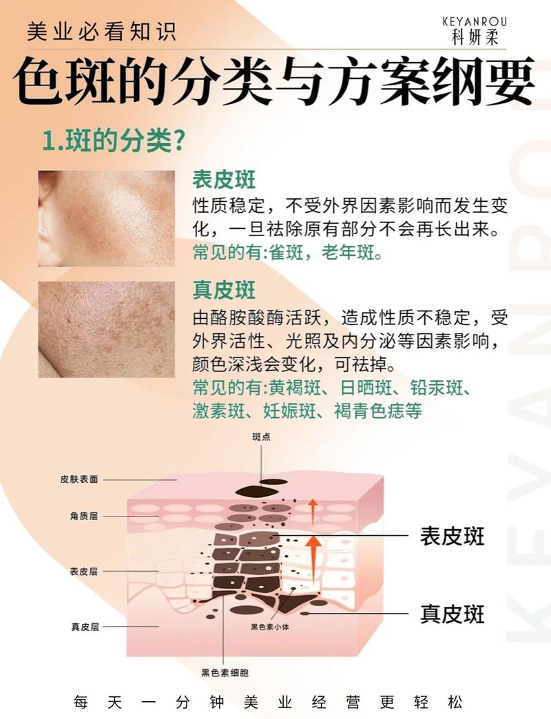 孕妇黄褐斑形成原因示意图