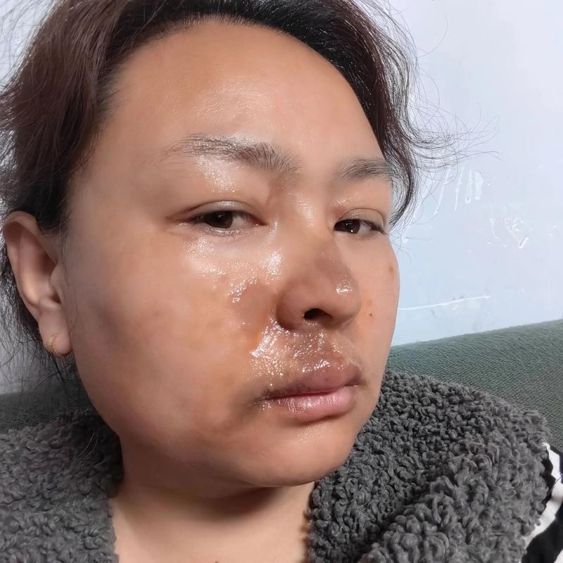 家用射频美容仪使用后皮肤烫伤对比图
