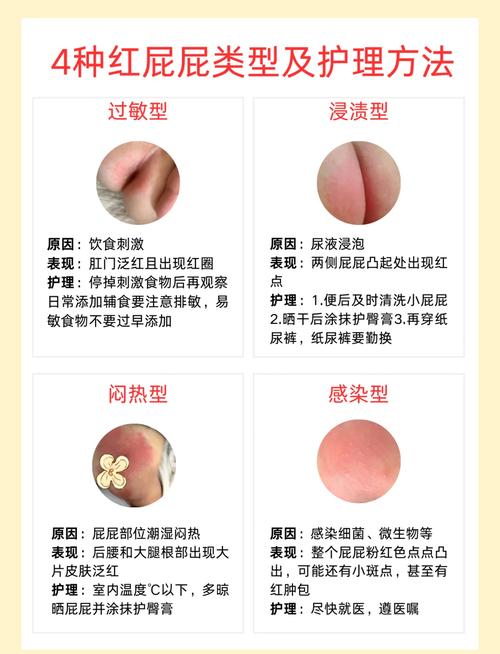 日常预防红屁屁的核心要点