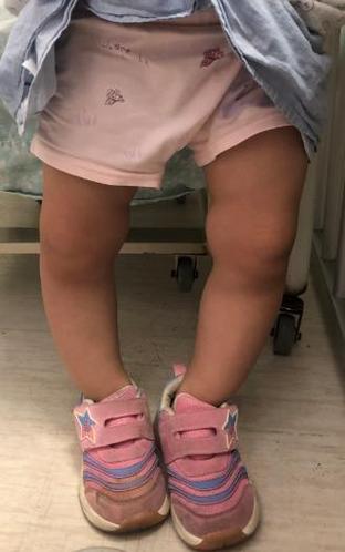 幼龄犬钙磷失衡引发O型腿临床实拍图