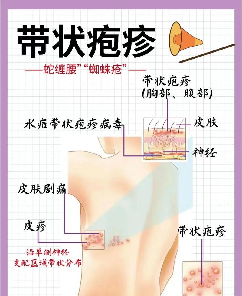 带状疱疹后遗神经痛的早期干预:别等痛到失眠才重视-仁者医