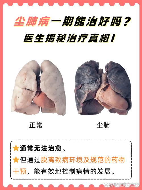 安全与健康：尘肺不是开玩笑的