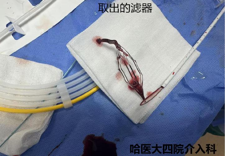 镍钛合金腔静脉过滤器体内取出物血栓形成照片
