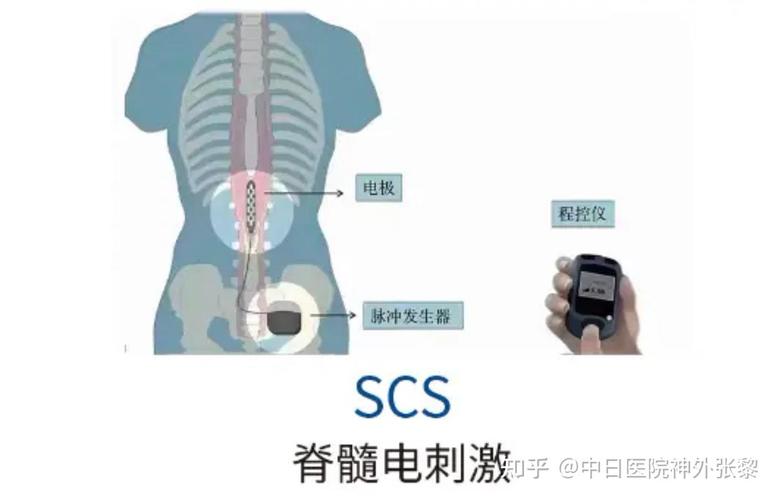 脊髓电刺激植入电极阵列示意图