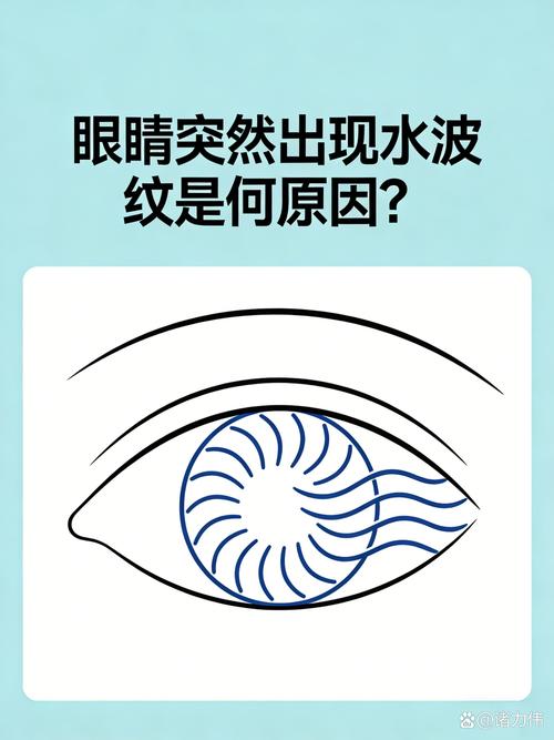 偏头痛视觉先兆水波纹示意图