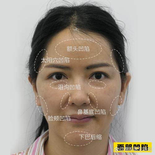 错误使用美容仪器导致面部凹陷示意图