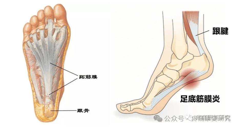 跟腱炎的鞋垫与拉伸训练:日常养护的实用经验分享-仁者医
