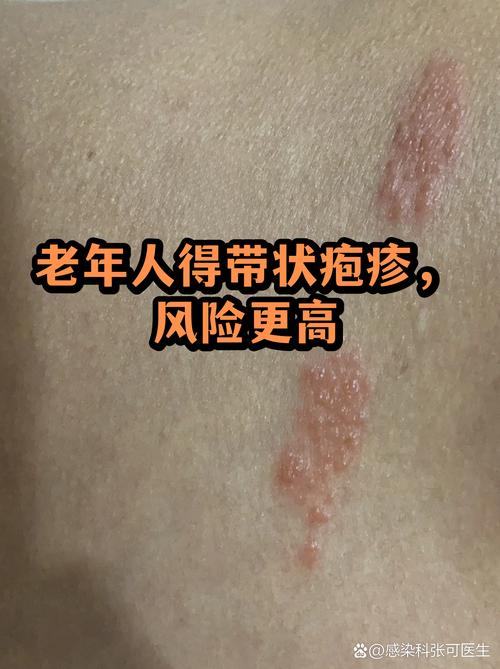 不同年龄带状疱疹后遗痛风险对比图