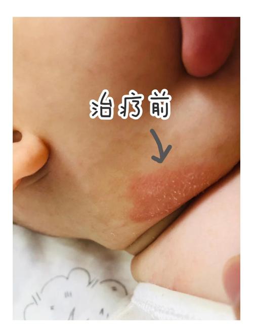 婴幼儿重症湿疹过敏皮损实拍图