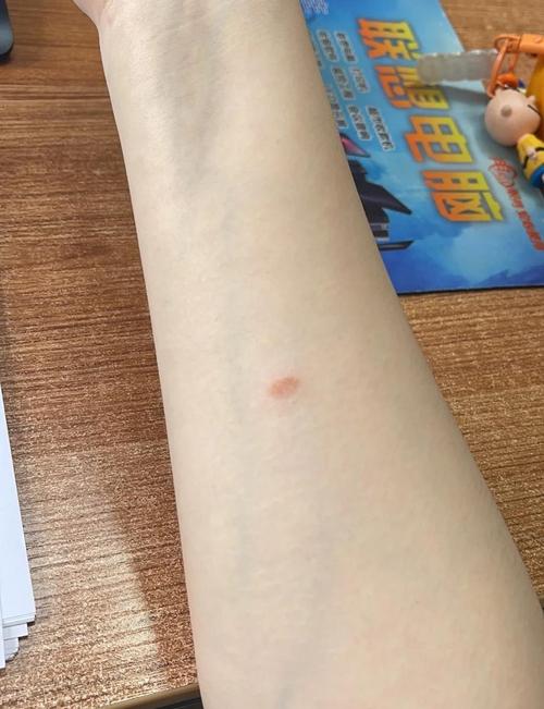 人感染皮肤型猫癣典型症状实拍