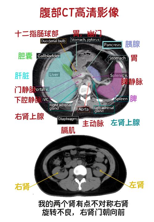 腹部CT扫描内脏脂肪测量影像图