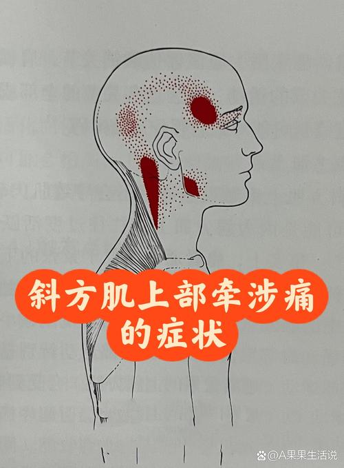 那个让我崩溃的痛点——上斜方肌的哀嚎
