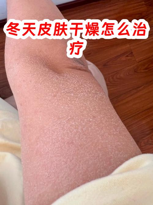 北方冬季暖气房干燥掉皮屑床单