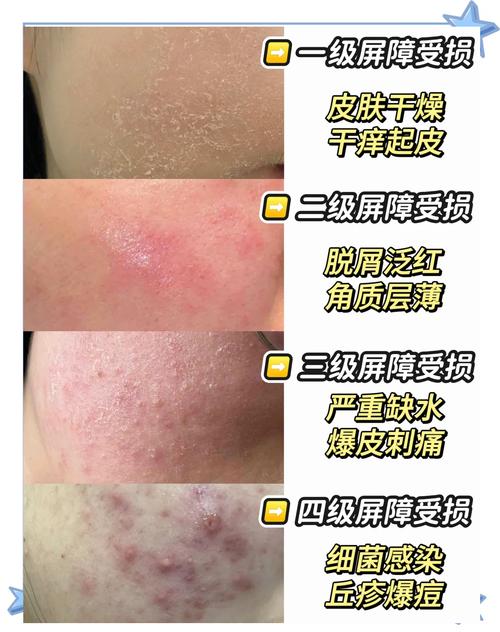 干燥季节过度清洁受损皮肤对比图