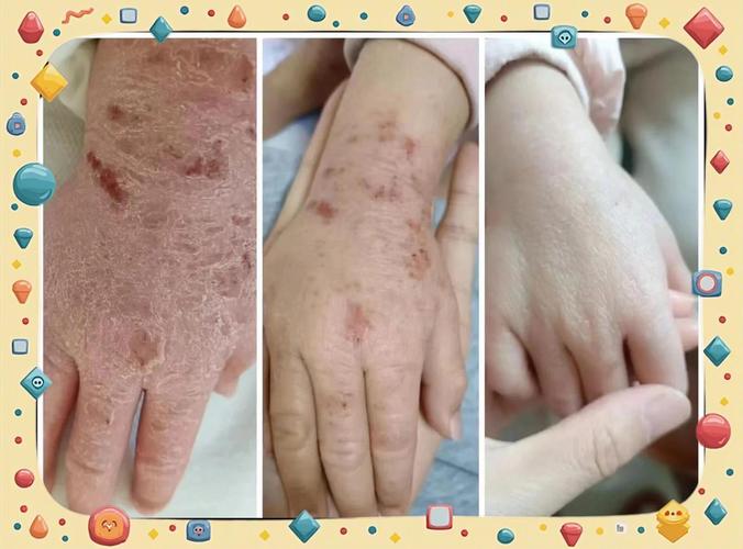 特应性皮炎儿童正常受损皮肤屏障对比图