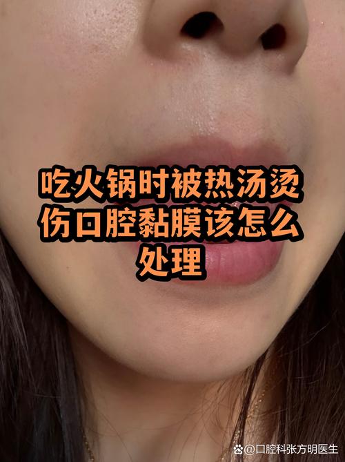 刚出锅热火锅烫口腔黏膜示意图