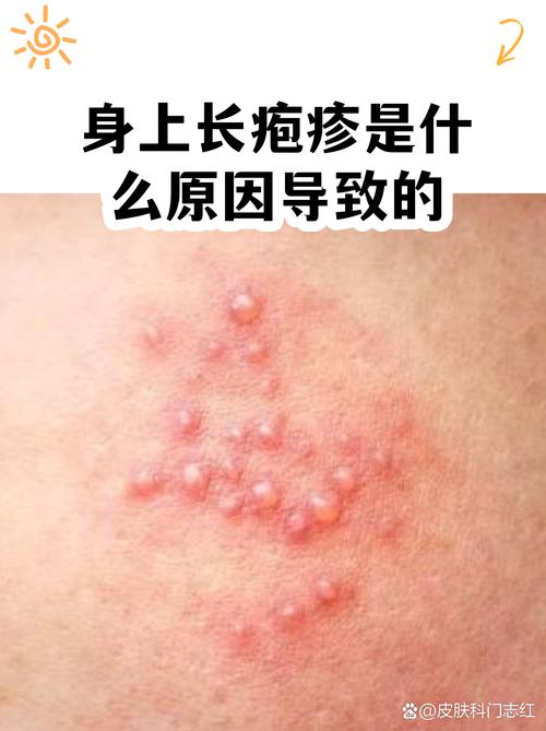 哪些情况容易触发疱疹病毒发病?