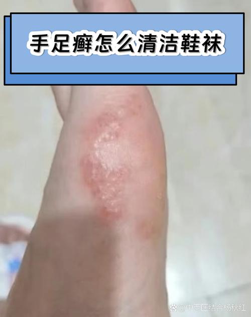 足癣患者日常换洗干净鞋袜摆放图
