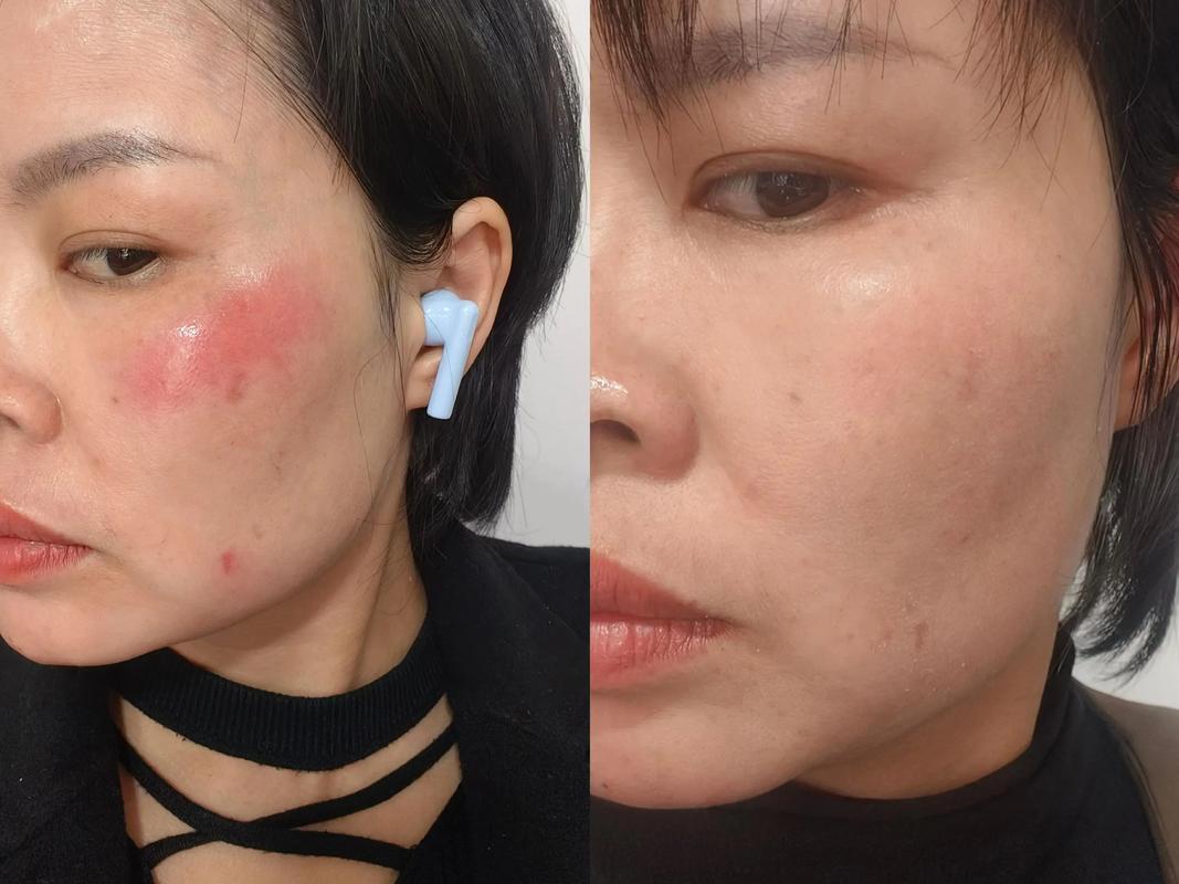 女性错误使用多款爽肤水导致皮肤泛红的场景