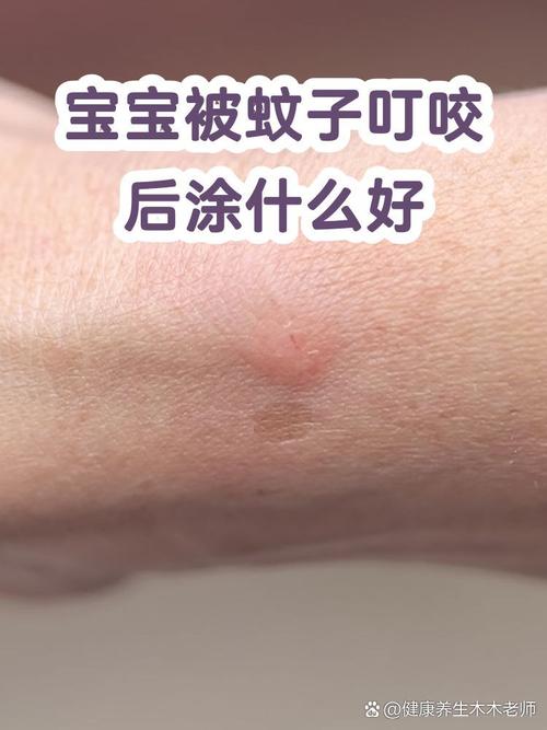 宝宝被咬了之后,别乱涂药膏