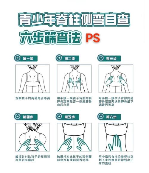 青少年脊柱侧弯弯腰筛查正确姿势图
