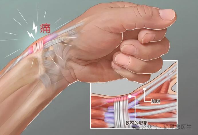 产后妈妈手腕疼痛腱鞘炎解剖位置示意图